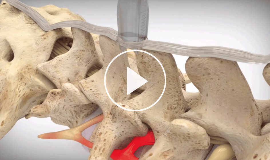 Video still of Boston Scientific animation