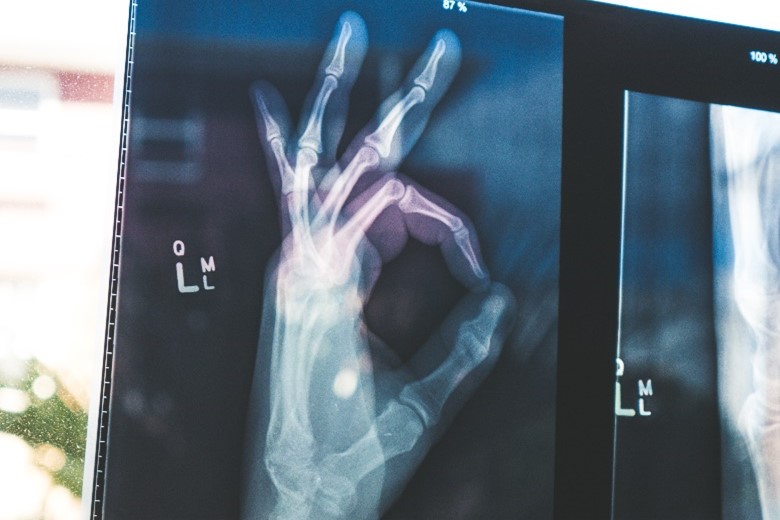 Should we operate on scaphoid waist fractures?