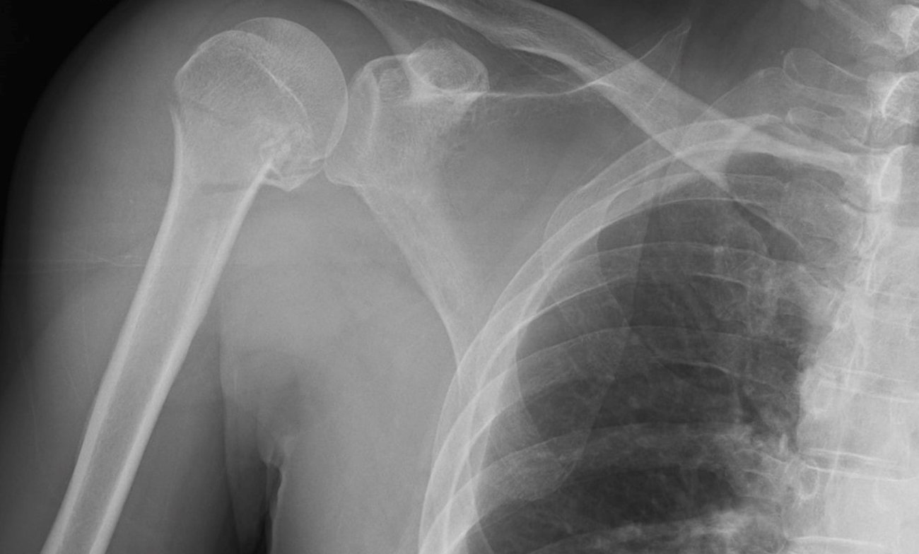 Optimal grafting for proximal humerus fractures