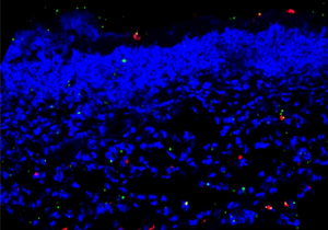 Speeding up diabetic wound healing