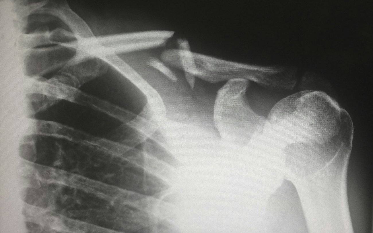 Wound complications in clavicle fracture surgery