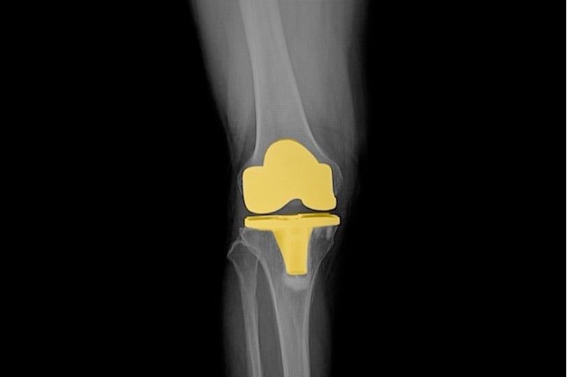 Optimal grafting for proximal humerus fractures