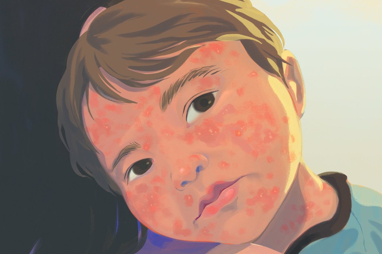 An illustration of a young boy, his face covered in measles, resting his head on his mother's shoulder An illustration of a young boy, his face covered in measles, resting his head on his mother's shoulder
