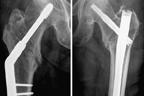 Managing post-op pain with CBD