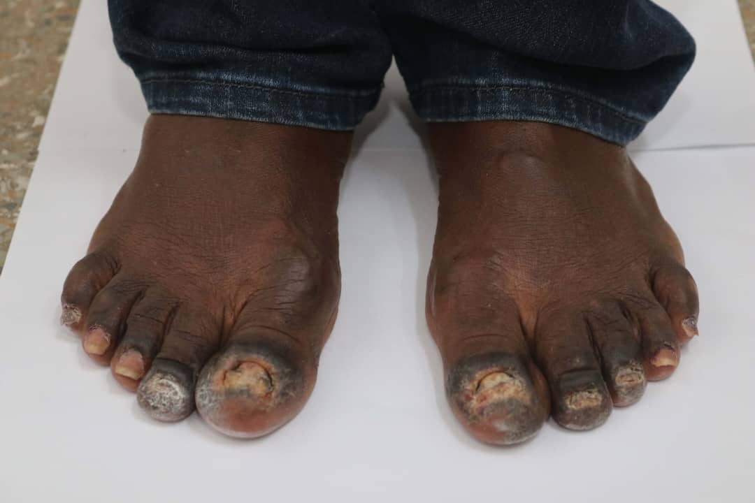 Figure 2 - Toenails before treatment Figure 2