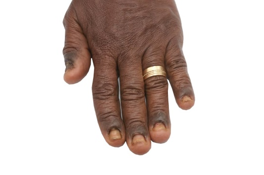 Figure 3b - Fingernails after 16 months of FGHP Figure 3