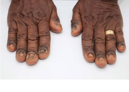 Figure 1 - Fingernails before treatment Figure 1
